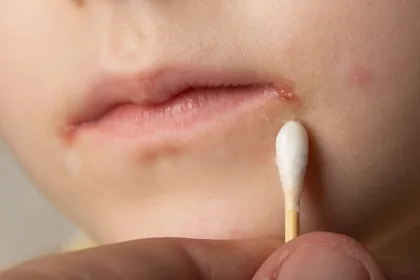 كل ما تحتاج معرفته عن هربس الشفاه وأعراضه