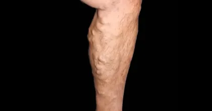 تخثر الدم: الأسباب والأعراض وسبل العلاج الفعالة