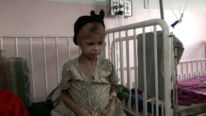 أكثر من 54 ألف طفل في غزة يعانون من سوء التغذية الحاد: الأزمة الإنسانية المتفاقمة