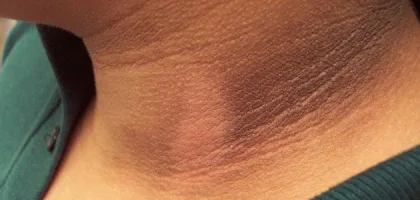 أسباب سواد الرقبة وطرق العلاج الطبيعية