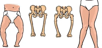 فيتامين د ومرض الكساح: العلاقة والتأثير
