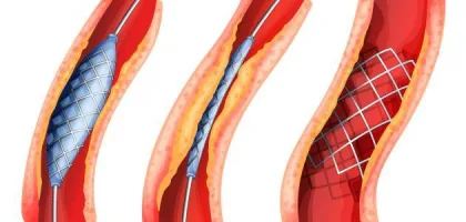 أسباب تصلب الشرايين وطرق الوقاية