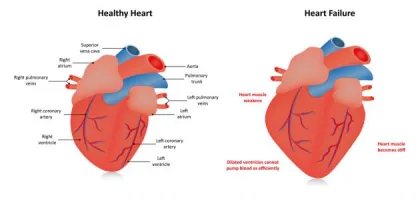 التهاب جدار القلب: الأعراض، الأسباب، والتشخيص