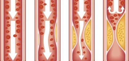 تصلب الشرايين: الأسباب والأعراض والتشخيص والعلاج