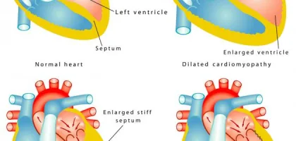 دعامات القلب: كل ما تحتاج معرفته