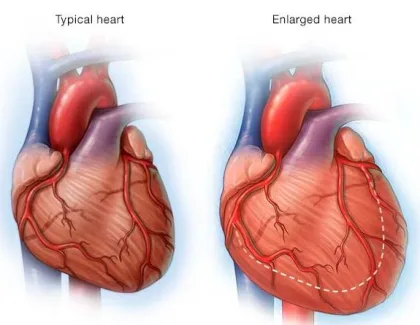 تضخّم القلب ليس مرضا بل تحذير مبكر من خطر خفي