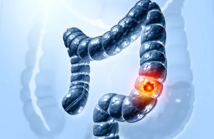 ماذا تأكل لتحمي نفسك من سرطان القولون؟