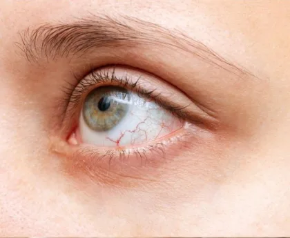 كيف تكشف العين العلامات المبكرة لأمراض القلب؟