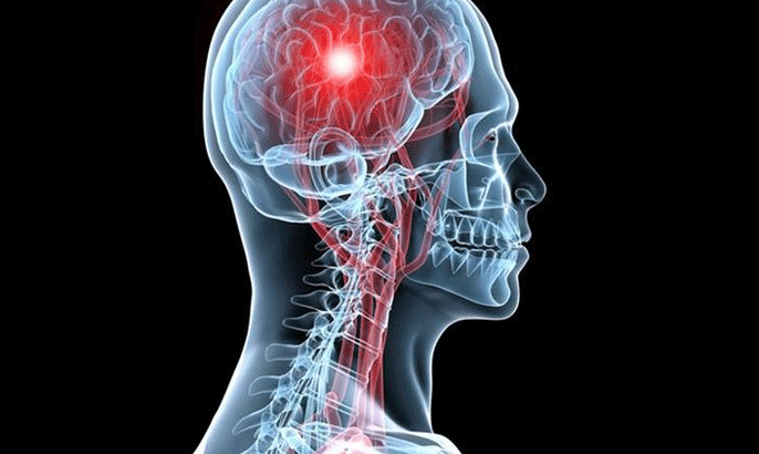 لماذا يصاب المزيد من الشباب بالسكتة الدماغية؟