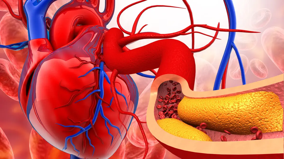 ارتفاع تصلب الشرايين بين الشباب.. الأسباب والحلول