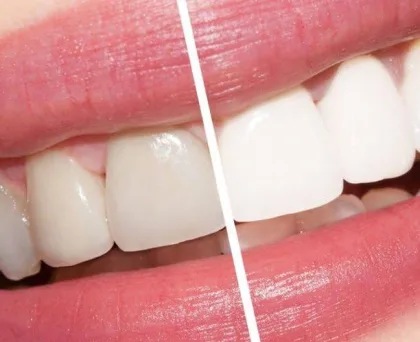 تبييض الأسنان بطرق طبيعية وآمنة