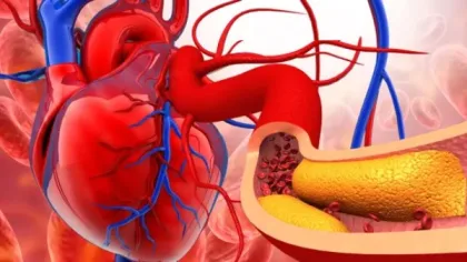 مشروبات بسيطة لتنظيف الشرايين بسهولة