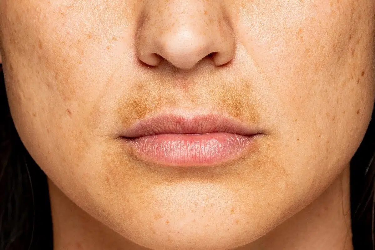 علاج التصبغات العنيدة وفقا لنتائج الدراسات الحديثة