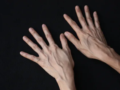 الأسباب العلمية لبروز شرايين اليد