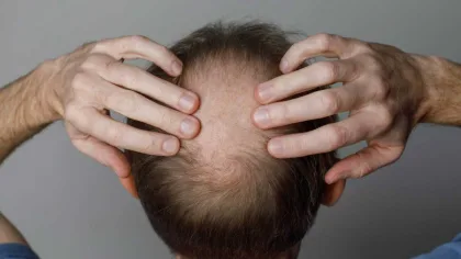 الصلع الوراثي.. تقنيات علاجية جديدة تتجاوز المينوكسيديل