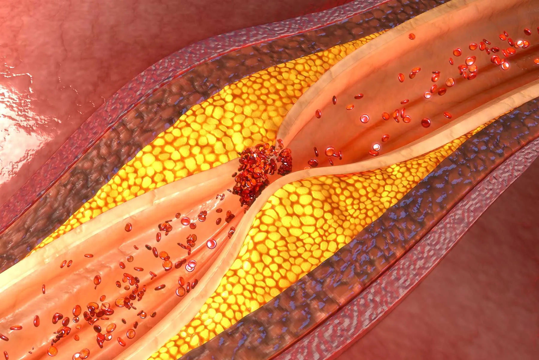 أحدث البروتوكولات العلاجية لتصلب الشرايين التاجية