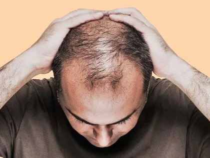 علاج تجريبي يحدث ثورة في علاج تساقط الشعر